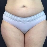 high def body sculpting Before & After Image