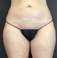 high def body sculpting Before & After Image