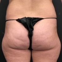 high def body sculpting Before & After Image