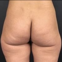 high def body sculpting Before & After Image