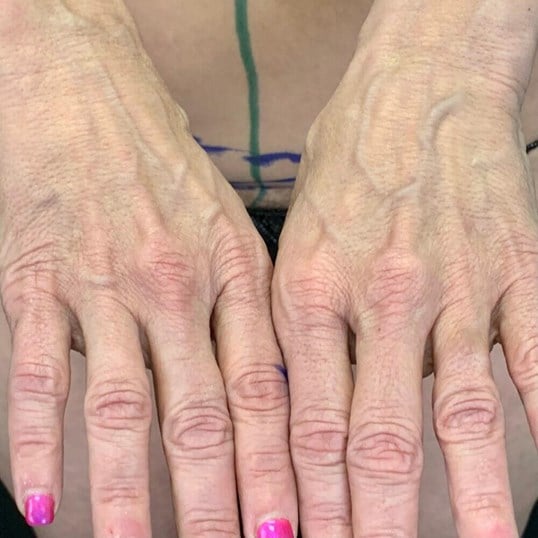 laser lipo and fat transfer Before & After Image