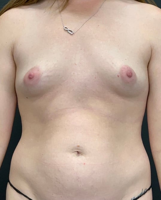 laser lipo and fat transfer Before & After Image