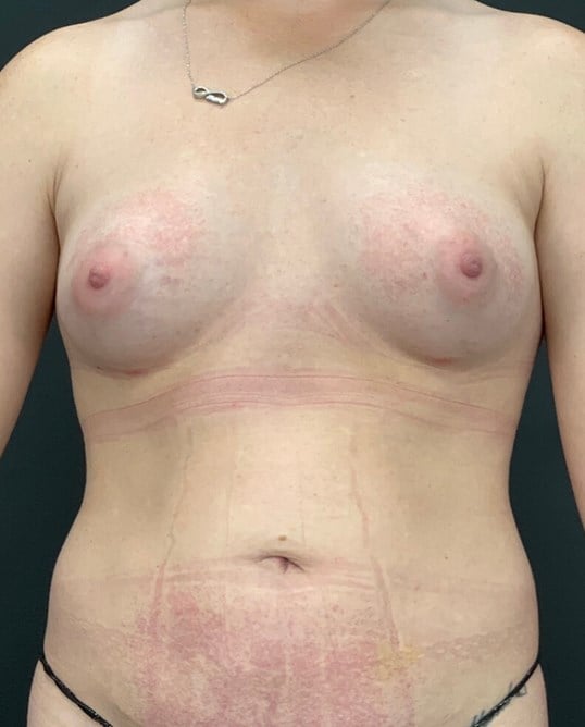 laser lipo and fat transfer Before & After Image