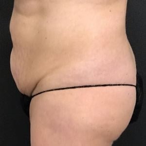 tummy tuck Before & After Image