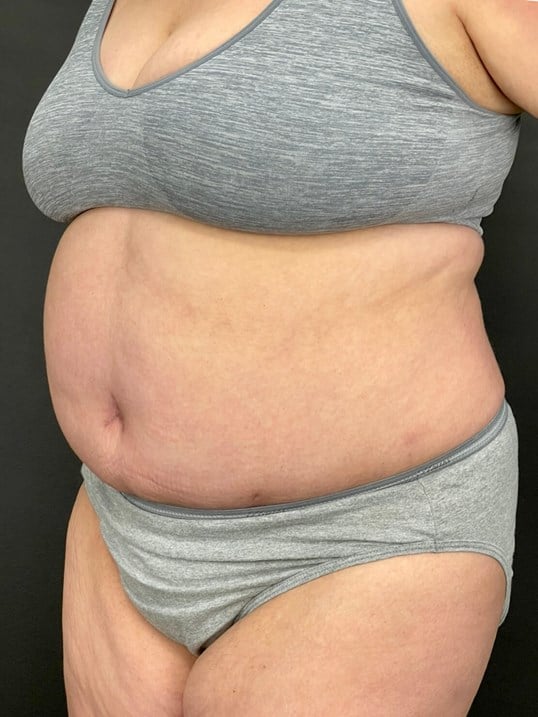 tummy tuck Before & After Image