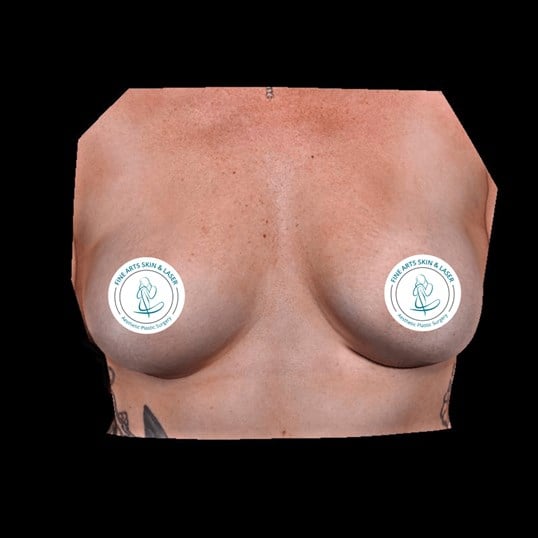 breast augmentation with implants Before & After Image