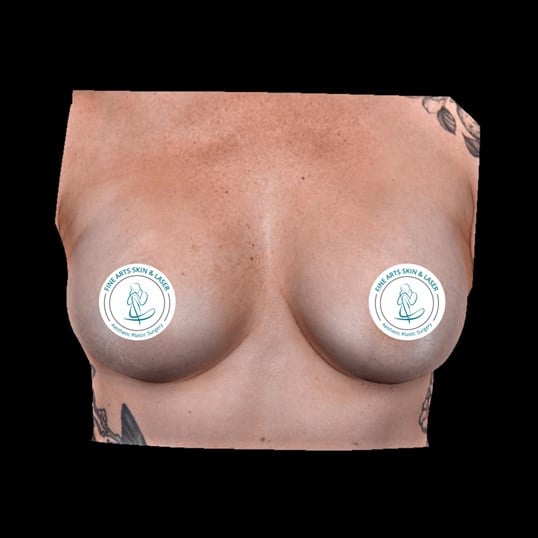 breast augmentation with implants Before & After Image