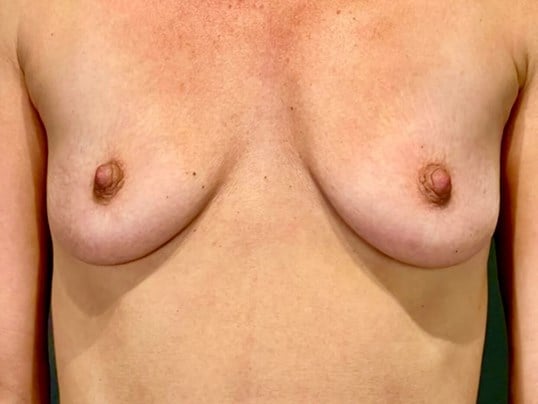 breast augmentation with implants Before & After Image