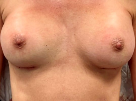 breast augmentation with implants Before & After Image