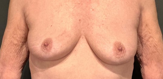 breast augmentation with implants Before & After Image