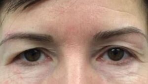 brow and forehead lift Before & After Image