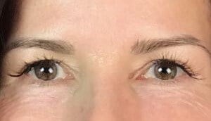 brow and forehead lift Before & After Image
