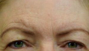 brow and forehead lift Before & After Image