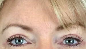 brow and forehead lift Before & After Image