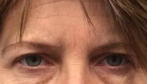 brow and forehead lift Before & After Image