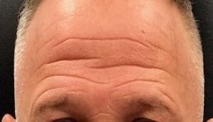 brow and forehead lift Before & After Image