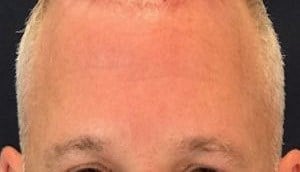 brow and forehead lift Before & After Image