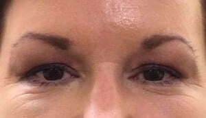 brow and forehead lift Before & After Image