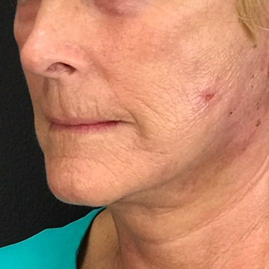facelift Before & After Image