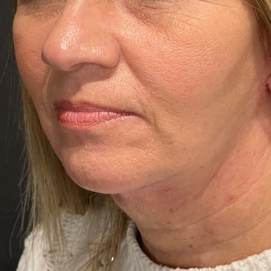 facelift Before & After Image