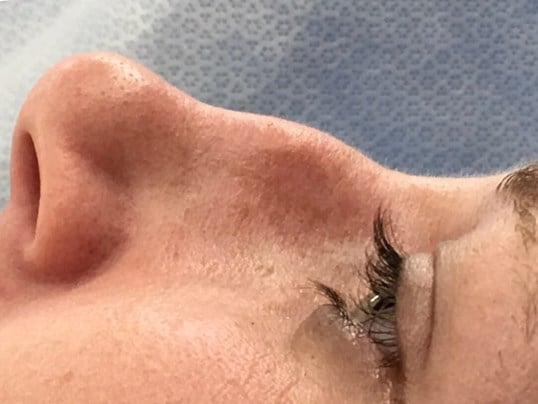 rhinoplasty Before & After Image