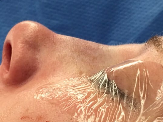 rhinoplasty Before & After Image