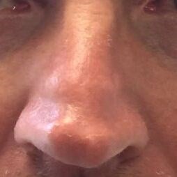 rhinoplasty Before & After Image