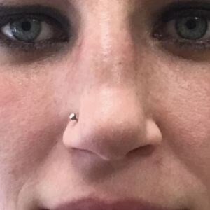 rhinoplasty Before & After Image