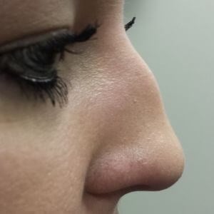 rhinoplasty Before & After Image