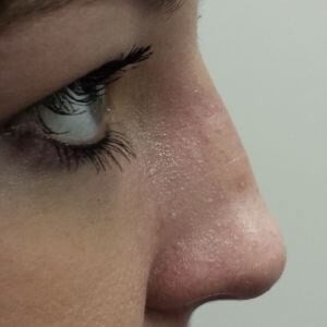 rhinoplasty Before & After Image