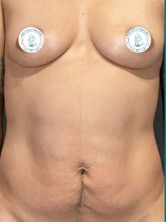 Patient Awake Surgery Before & After Image