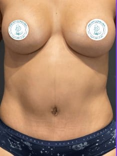 Patient Awake Surgery Before & After Image