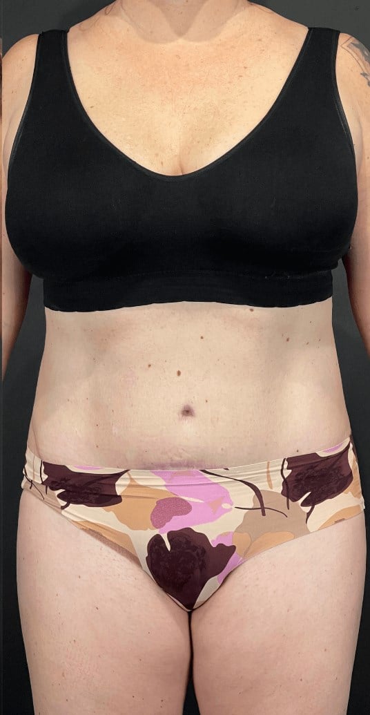 Patient Awake Surgery Before & After Image