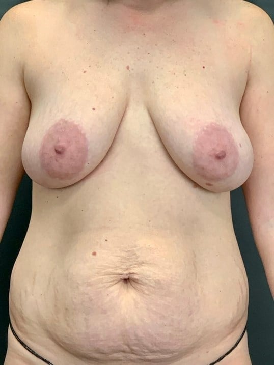 Body Sculpting Before & After Image
