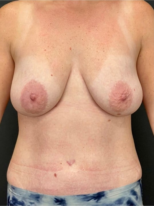 Body Sculpting Before & After Image