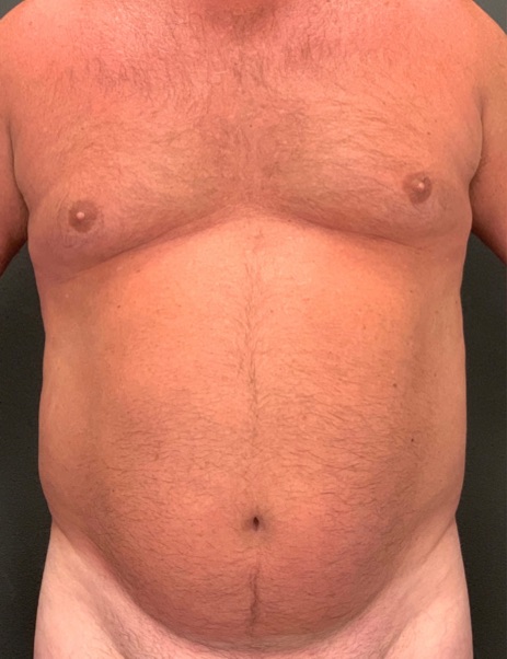 Body Sculpting Before & After Image