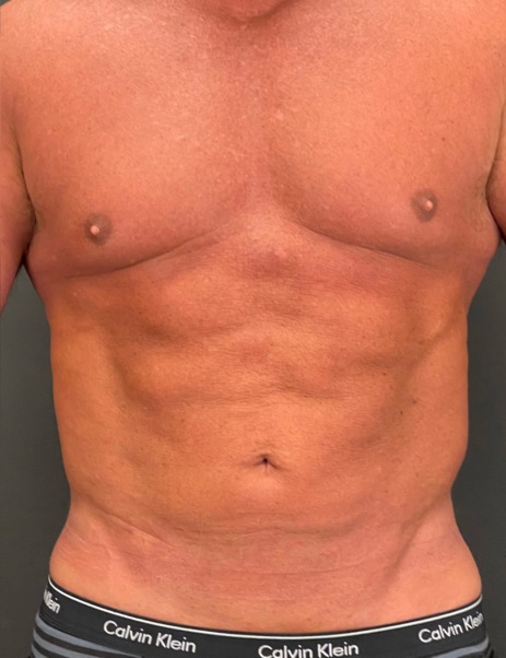 Body Sculpting Before & After Image