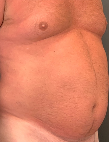 Body Sculpting Before & After Image