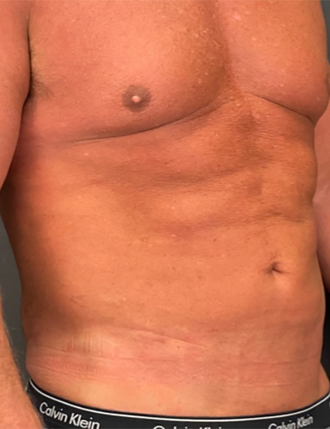Body Sculpting Before & After Image