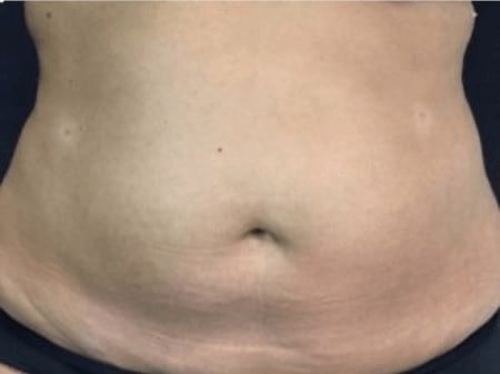 High Def Body Sculpting Before & After Image