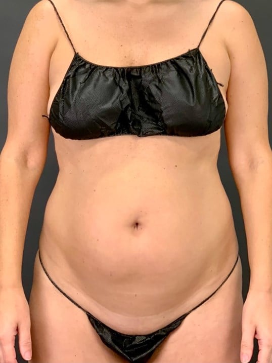 High Def Body Sculpting Before & After Image