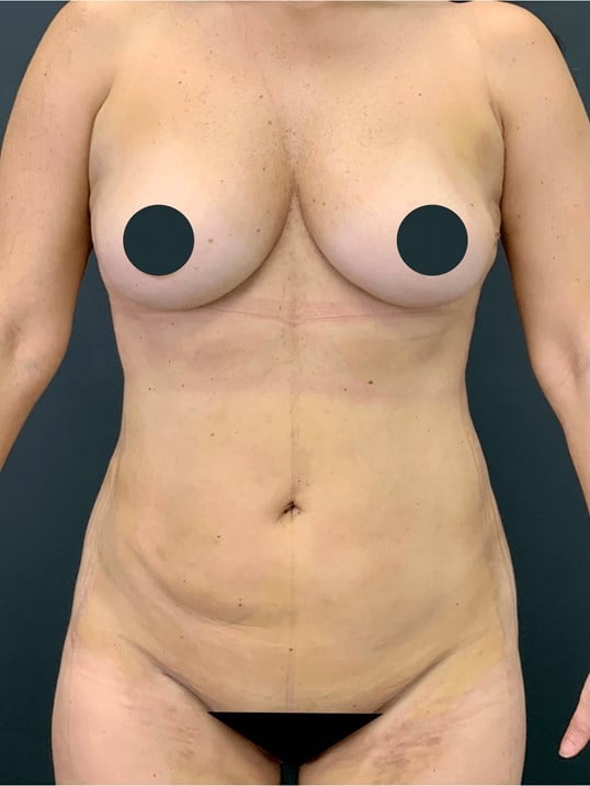 High Def Body Sculpting Before & After Image