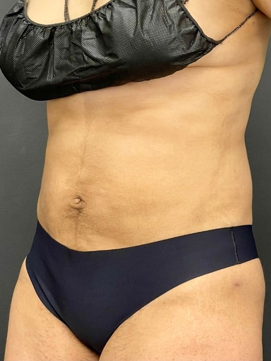 High Def Body Sculpting Before & After Image
