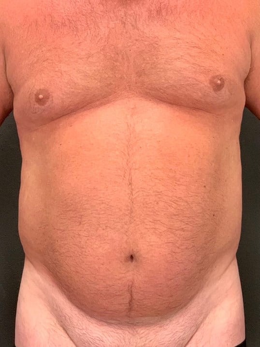High Def Body Sculpting Before & After Image