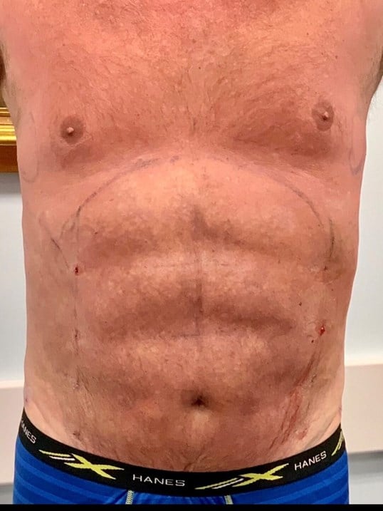High Def Body Sculpting Before & After Image