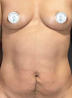 Laser Lipo And Fat Transfer Before & After Image