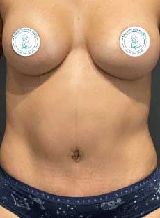 Laser Lipo And Fat Transfer Before & After Image