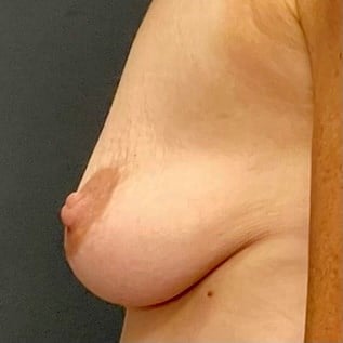 Living Fat Transfer Before & After Image