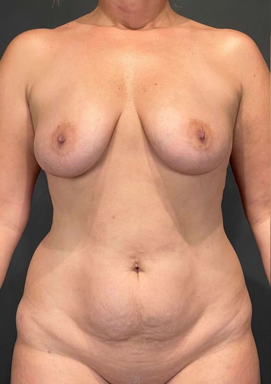 Mommy Makeover Before & After Image