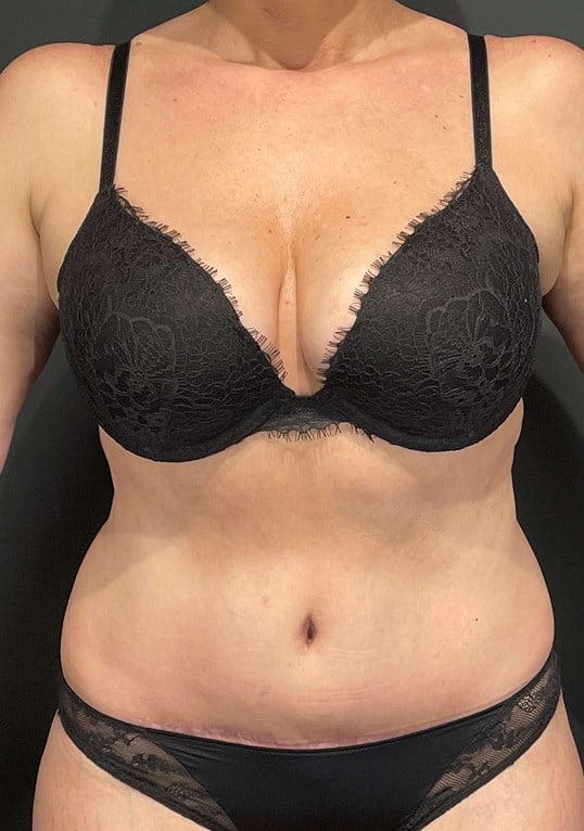 Mommy Makeover Before & After Image